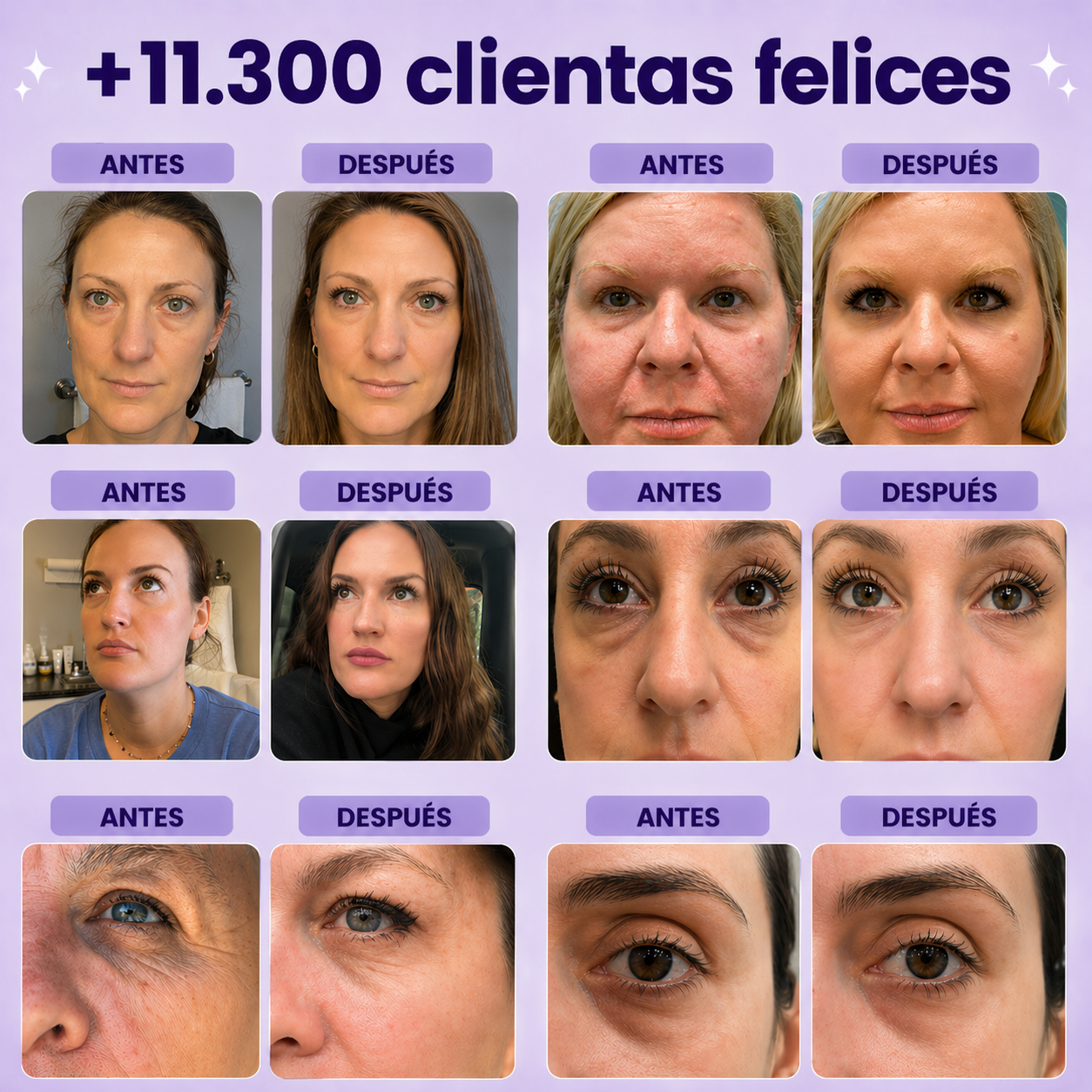 Set 2 Parches Anti-Ojeras Extras